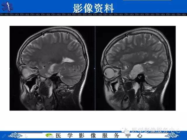 【病例】胚胎发育不良性神经上皮肿瘤DNET一例MR影像表现