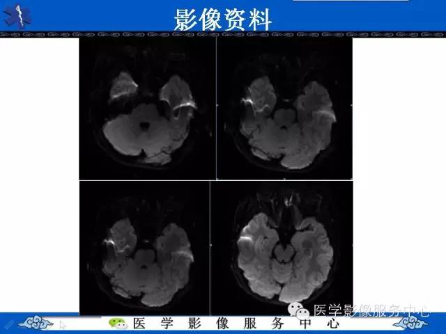 【病例】胚胎发育不良性神经上皮肿瘤DNET一例MR影像表现