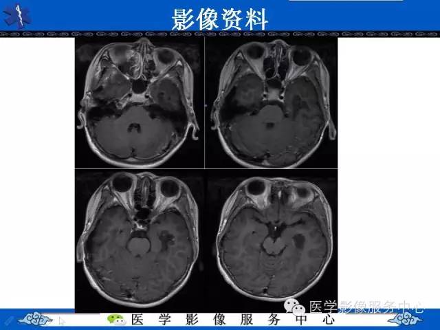 【病例】胚胎发育不良性神经上皮肿瘤DNET一例MR影像表现