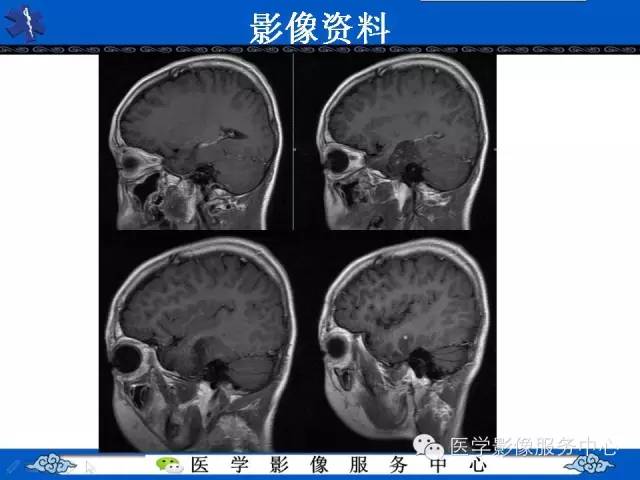 【病例】胚胎发育不良性神经上皮肿瘤DNET一例MR影像表现