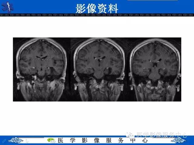 【病例】胚胎发育不良性神经上皮肿瘤DNET一例MR影像表现