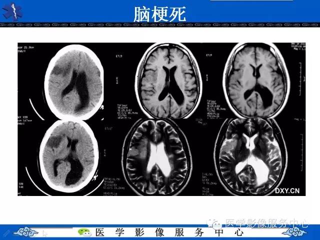 【病例】胚胎发育不良性神经上皮肿瘤DNET一例MR影像表现