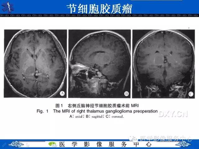 【病例】胚胎发育不良性神经上皮肿瘤DNET一例MR影像表现