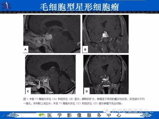 【病例】胚胎发育不良性神经上皮肿瘤DNET一例MR影像表现