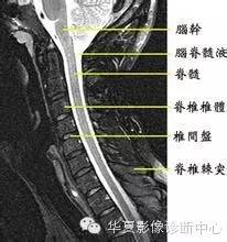 脊髓疾病MR诊断总结