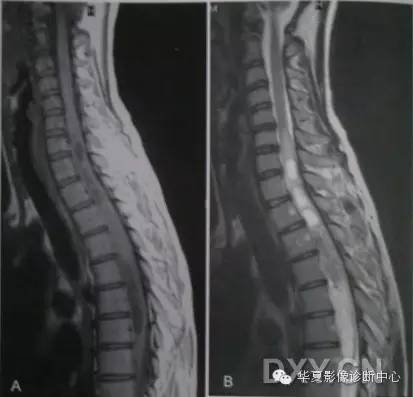 脊髓疾病MR诊断总结 脊髓疾病MR诊断总结