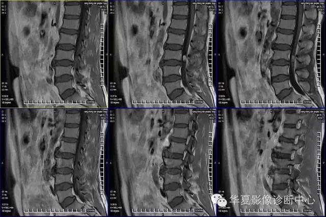 脊髓疾病MR诊断总结 脊髓疾病MR诊断总结