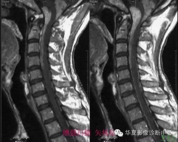 脊髓疾病MR诊断总结 脊髓疾病MR诊断总结