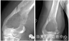 【病例】右肱骨腺泡状肉瘤1例