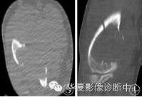 【病例】右肱骨腺泡状肉瘤1例 【病例】右肱骨腺泡状肉瘤1例