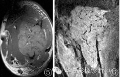 【病例】右肱骨腺泡状肉瘤1例 【病例】右肱骨腺泡状肉瘤1例