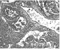 【病例】右肱骨腺泡状肉瘤1例 【病例】右肱骨腺泡状肉瘤1例