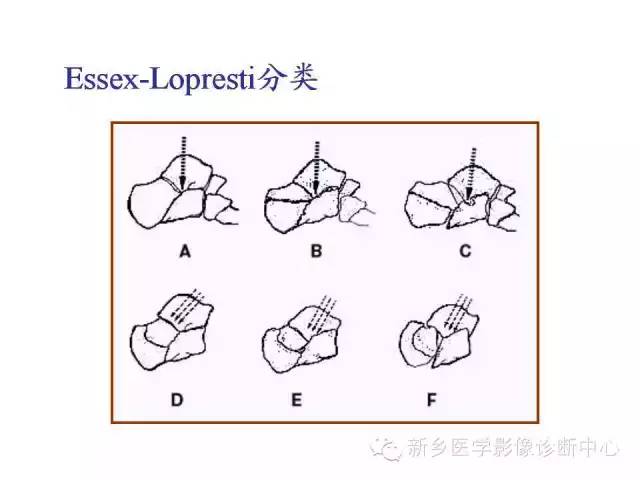 跟骨骨折的分型与图解