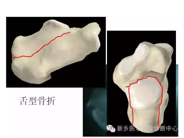 跟骨骨折的分型与图解