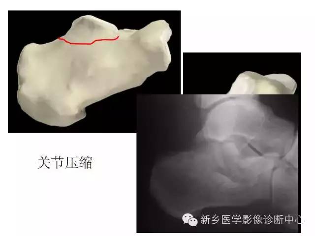 跟骨骨折的分型与图解