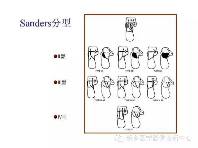 跟骨骨折的分型与图解