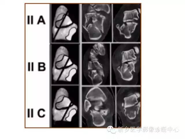 跟骨骨折的分型与图解