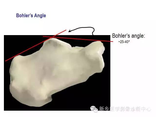 跟骨骨折的分型与图解
