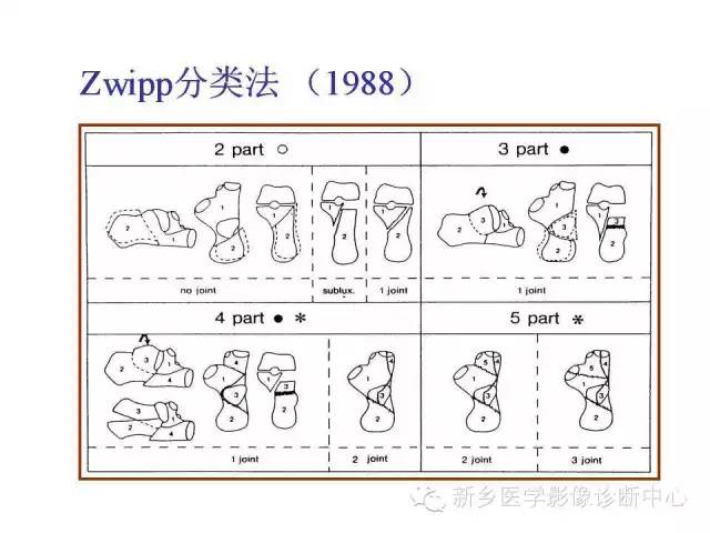跟骨骨折的分型与图解