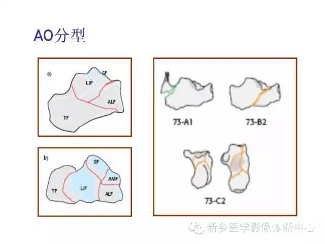 跟骨骨折的分型与图解