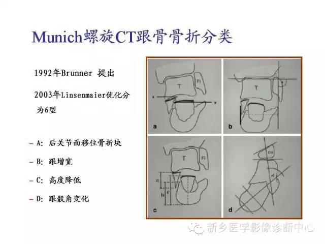 跟骨骨折的分型与图解