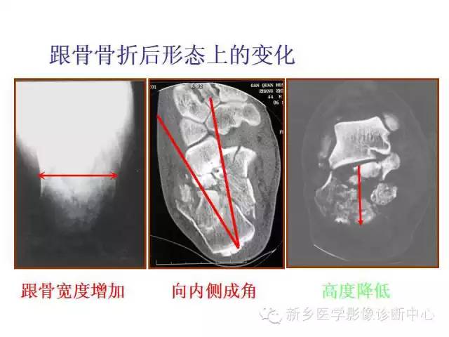 跟骨骨折的分型与图解