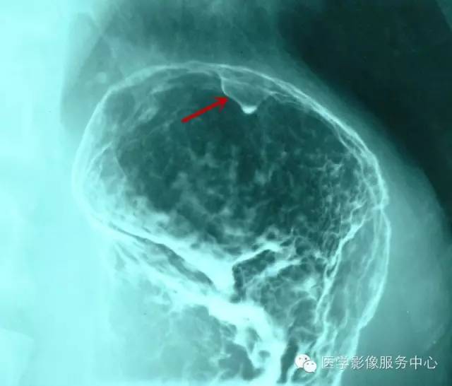 胃底息肉的 胃底息肉的