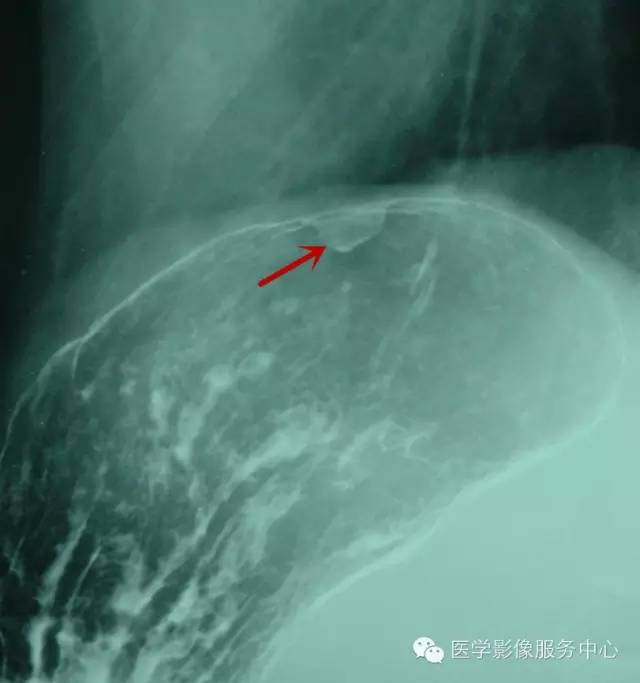 胃底息肉的 胃底息肉的