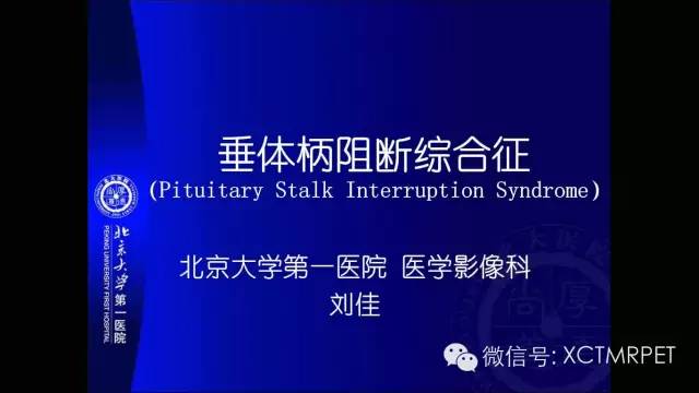 【PPT】垂体柄阻断综合征