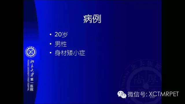 【PPT】垂体柄阻断综合征
