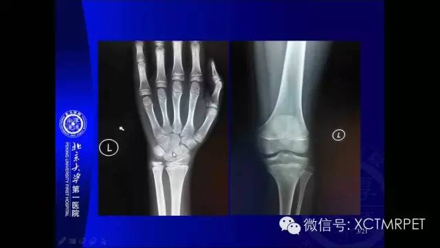 【PPT】垂体柄阻断综合征