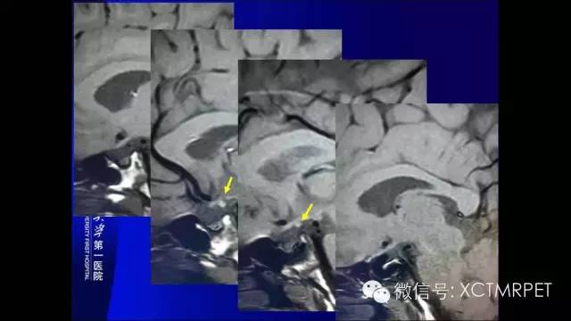 【PPT】垂体柄阻断综合征