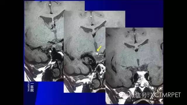 【PPT】垂体柄阻断综合征