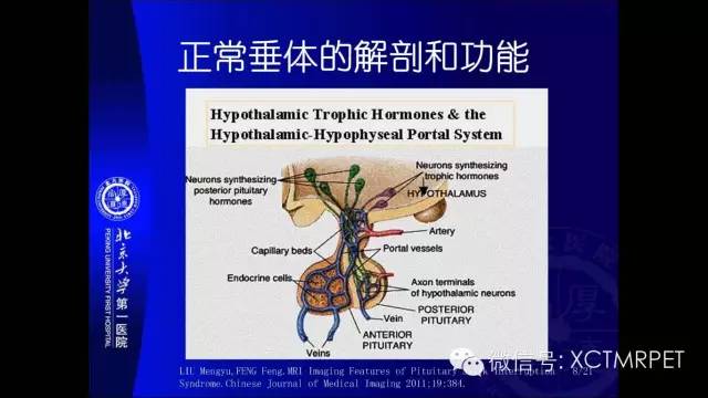 【PPT】垂体柄阻断综合征