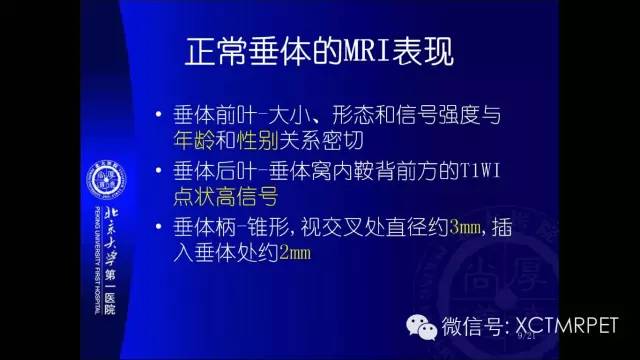 【PPT】垂体柄阻断综合征