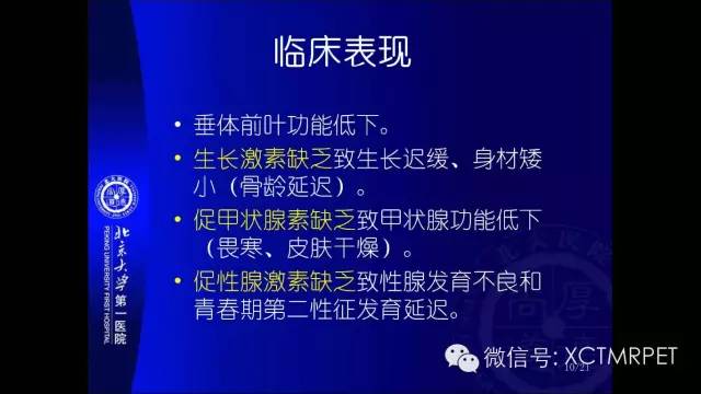 【PPT】垂体柄阻断综合征