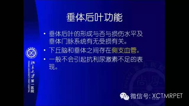 【PPT】垂体柄阻断综合征