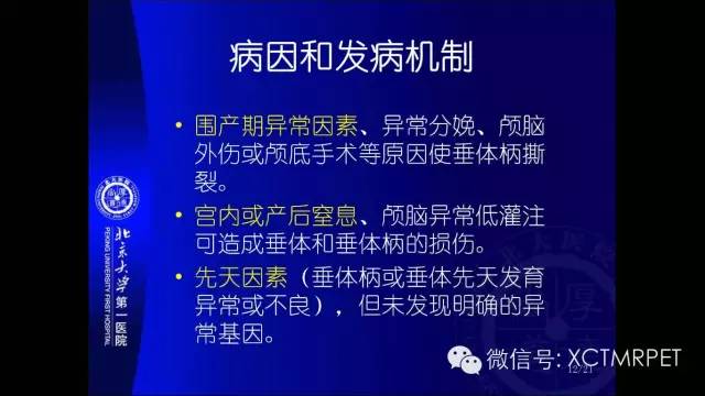 【PPT】垂体柄阻断综合征