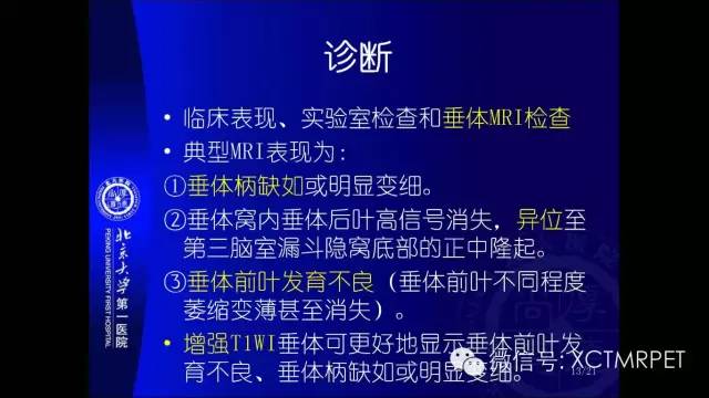 【PPT】垂体柄阻断综合征