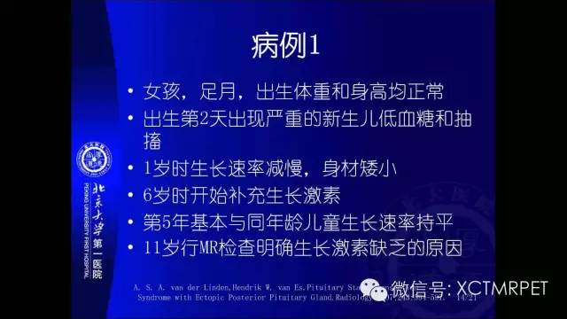 【PPT】垂体柄阻断综合征