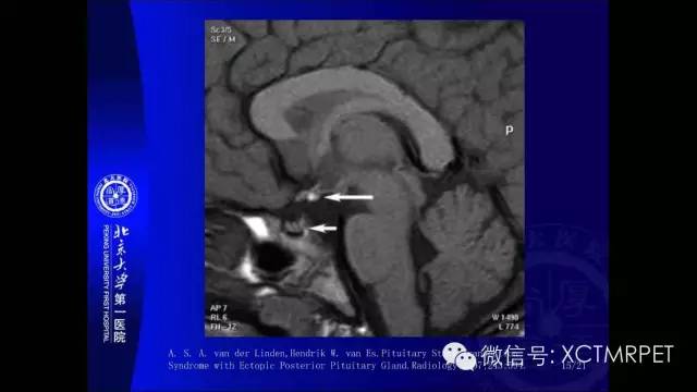 【PPT】垂体柄阻断综合征