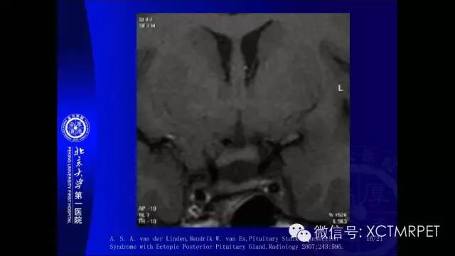 【PPT】垂体柄阻断综合征