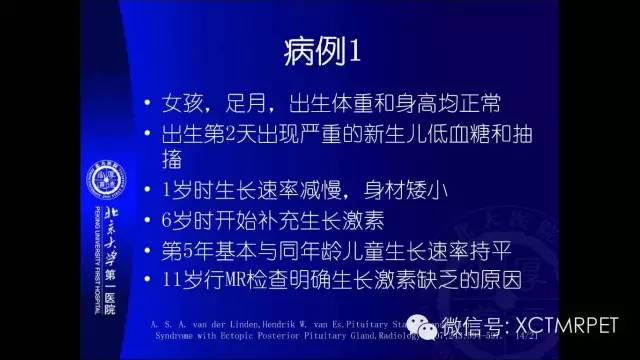 【PPT】垂体柄阻断综合征
