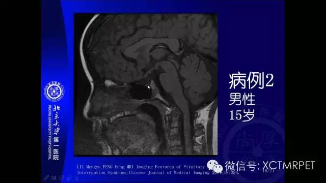 【PPT】垂体柄阻断综合征