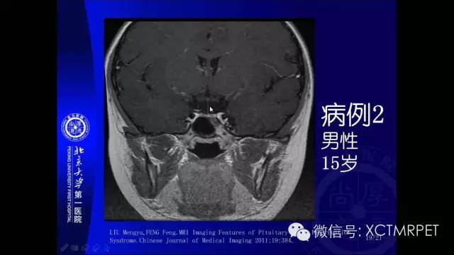 【PPT】垂体柄阻断综合征