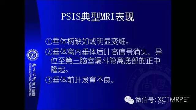 【PPT】垂体柄阻断综合征