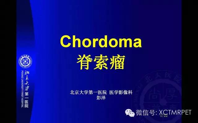 【PPT】脊索瘤