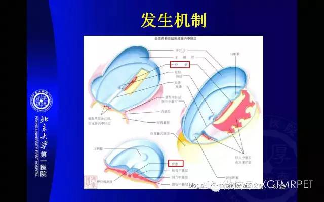 【PPT】脊索瘤