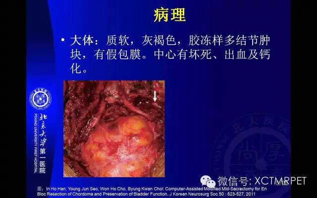 【PPT】脊索瘤