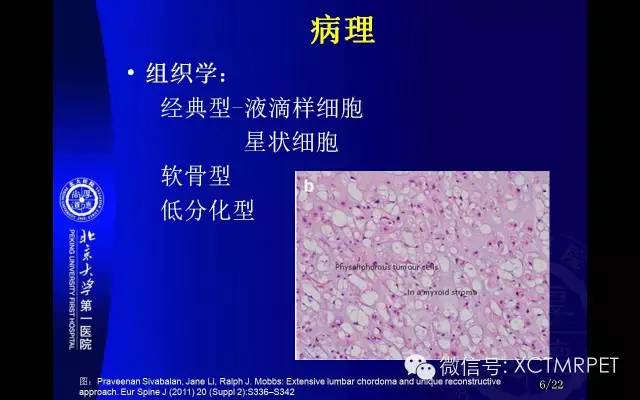 【PPT】脊索瘤